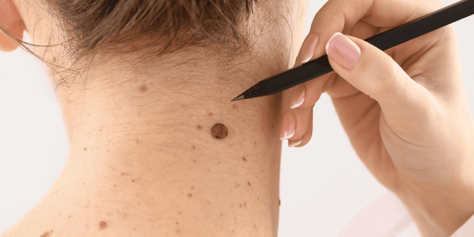 Mole & Skin Tag Removal