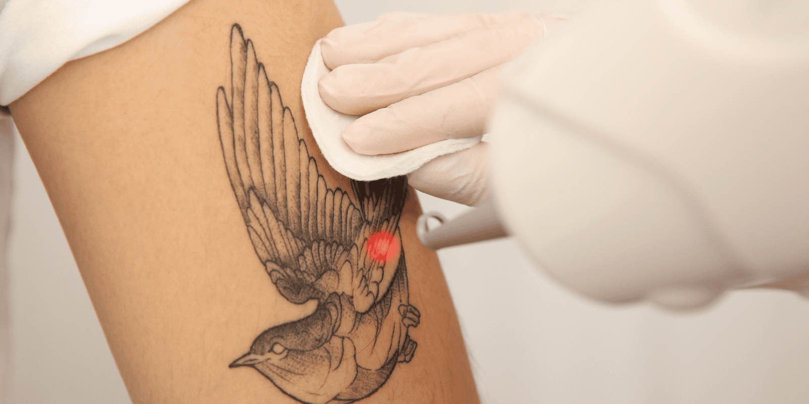 Close-up image of someone's arm with a tattoo on getting their tattoo removed with a laser