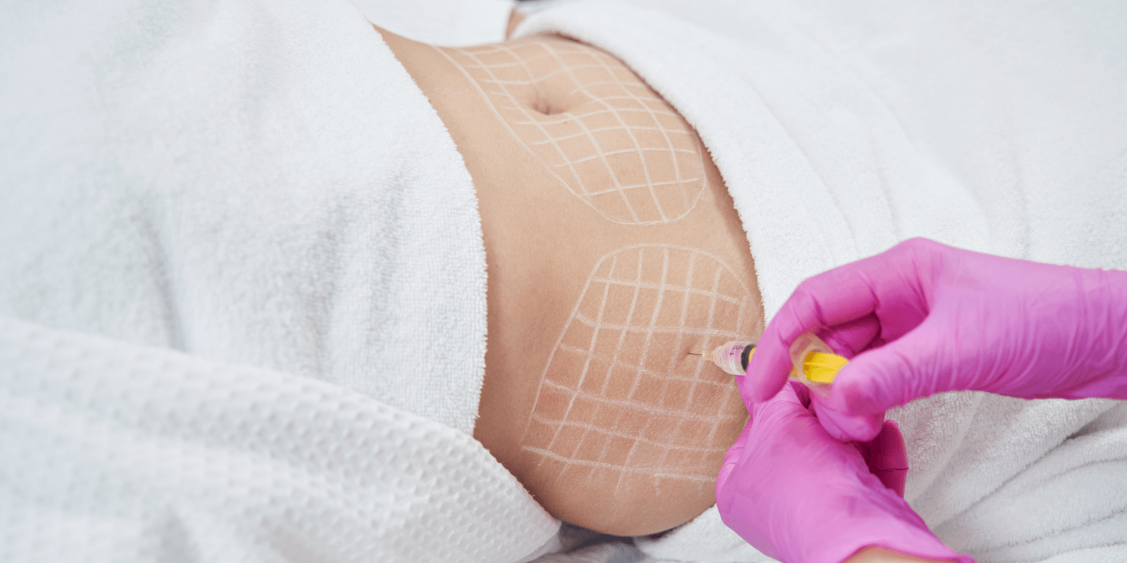 Practitioner injecting a fat dissolving treatment into the abdomen