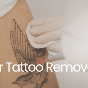 Level 5 course banner: Laser Tattoo Removal