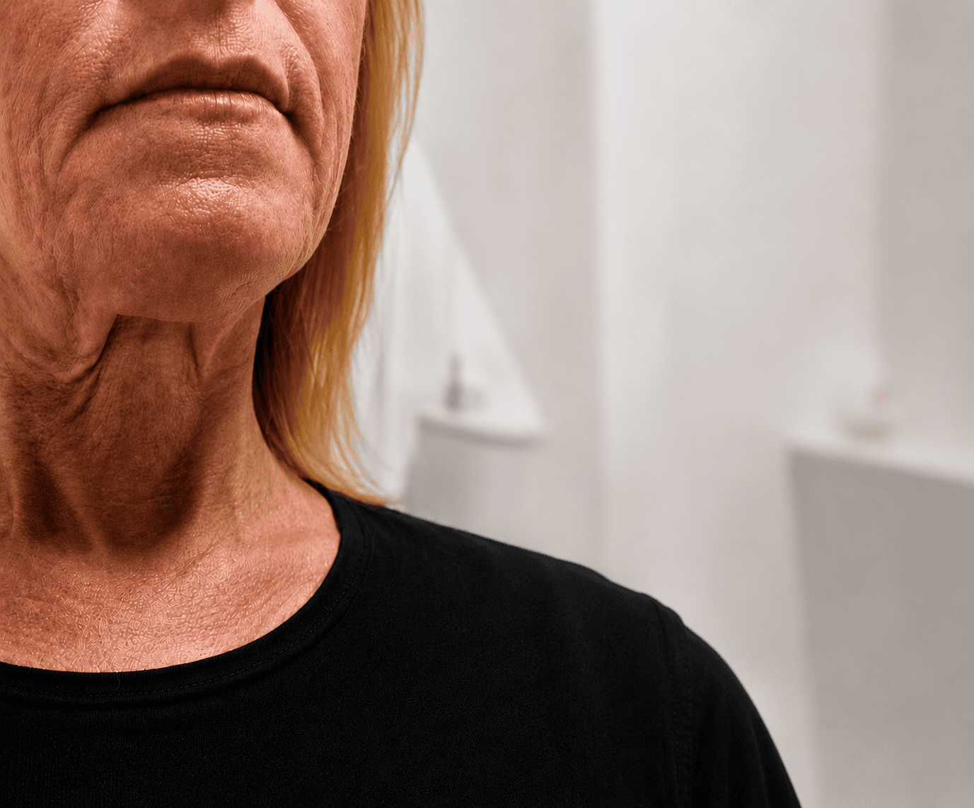 Before Endolift treatment