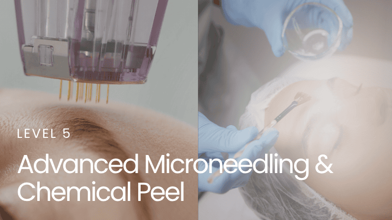 Advanced Microneedling & Chemical Peel – Level 5